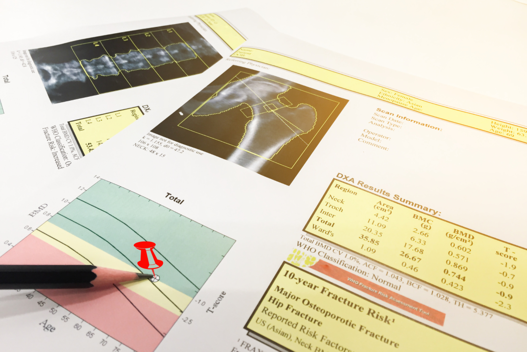 Kết quả đo mật độ xương giúp đánh giá sức khỏe xương của bệnh nhân