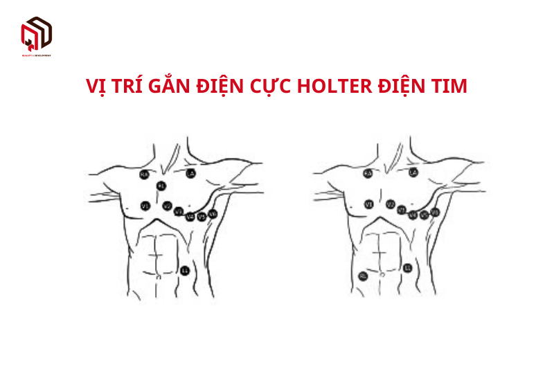 Minh hoạ vị trí gắn các điện cực holter điện tim