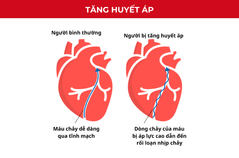 Tăng huyết áp xảy ra khi áp lực máu trong động mạch tăng cao