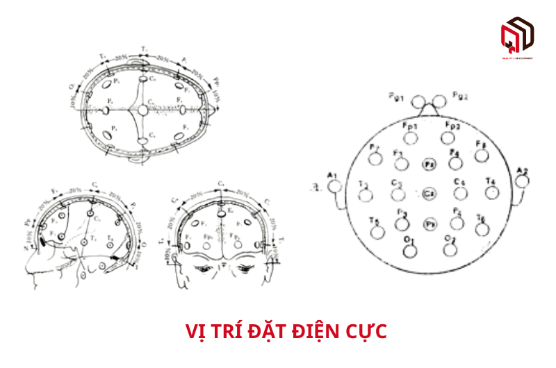 Vị trí đặt điện cực máy điện não