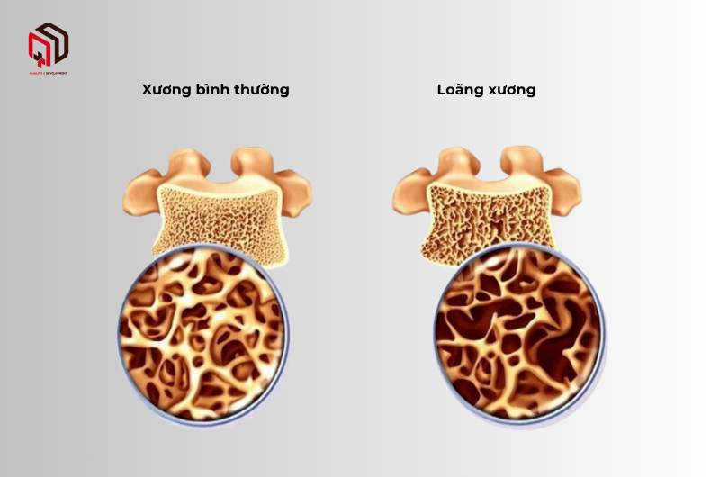 Tổng quan về bệnh loãng xương