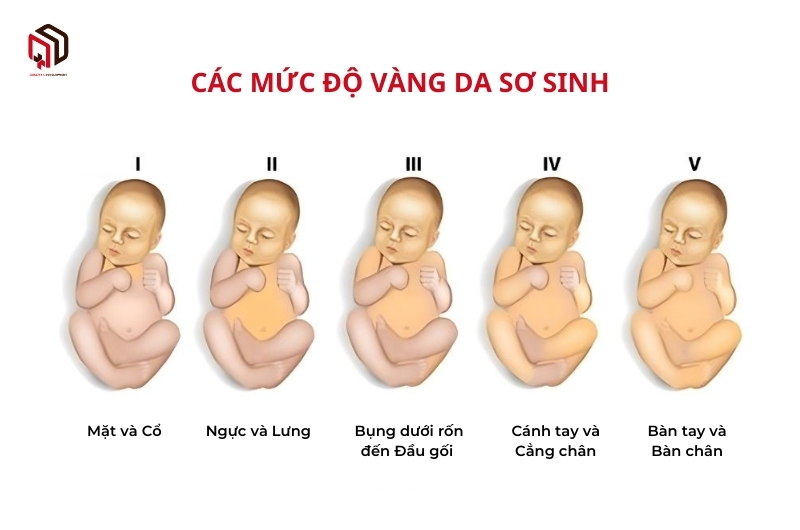 Các mức độ vàng da sơ sinh